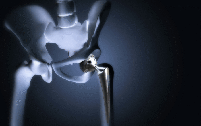 Lesão no menisco: como acontece, sintomas e tratamento prótese de quadril